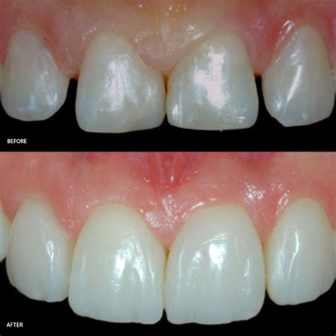 direct composite veneers.